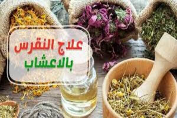 علاج النقرس بالأعشاب