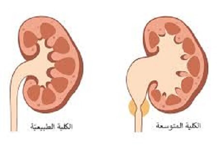 اسباب اتساع حوض الكلى