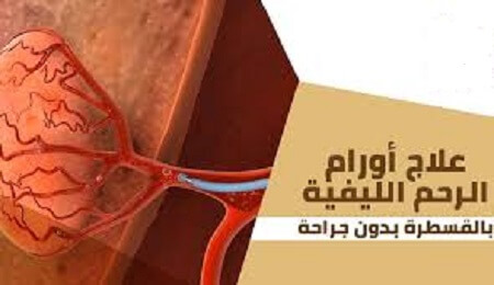 الأشعة التداخلية